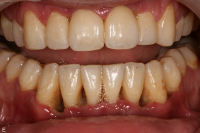 Nekrotiserande ulcer&ouml;s gingivit