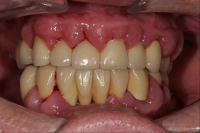 L&auml;kemedelsinducerad gingival hyperplasi